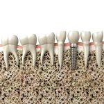 Dental implant