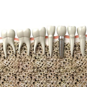 dental-implant-3d-model-obj-3ds-fbx-blend