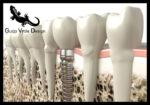 Dental implant