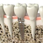 Dental implant