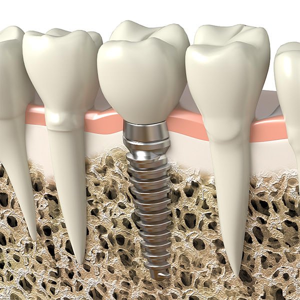 Dental implant
