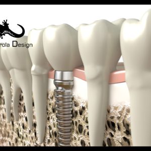 Dental implant