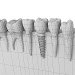 Dental implant