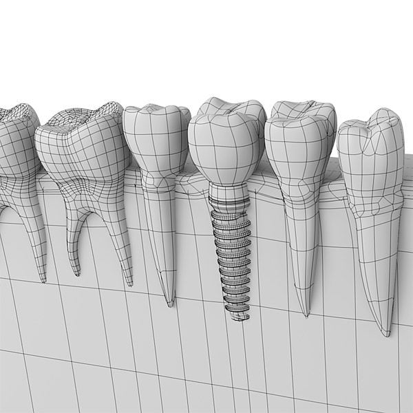 Dental implant