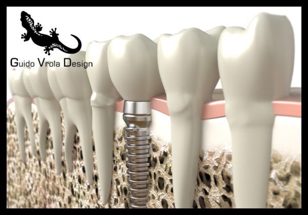 Dental implant