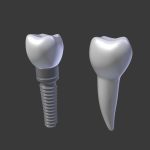 Tooth Implant - premolar