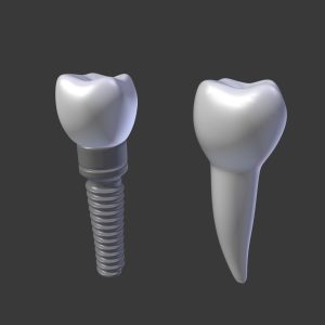 tooth-implant-premolar-3d-model-low-poly-obj-mtl-3ds-fbx-stl-blend-dae