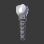 Tooth Implant - premolar