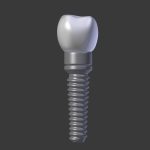 Tooth Implant - premolar