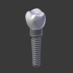 Tooth Implant - premolar