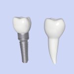 Tooth Implant - premolar