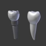 Tooth Implant - premolar