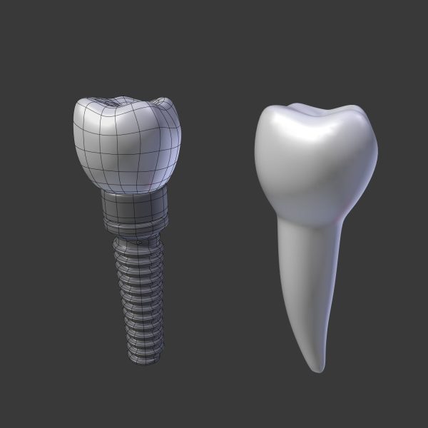 Tooth Implant - premolar