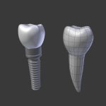 Tooth Implant - premolar