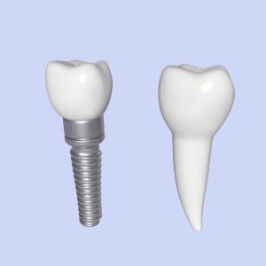 Tooth Implant - premolar