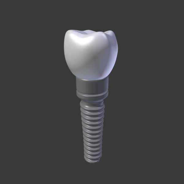 Tooth Implant - premolar