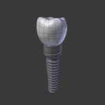 Tooth Implant - premolar