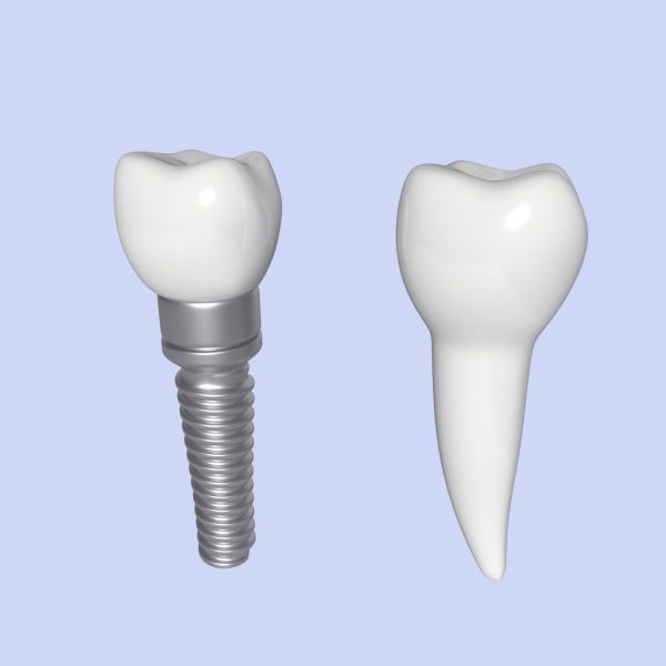 Tooth Implant - premolar
