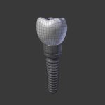 Tooth Implant - premolar