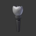 Tooth Implant - premolar
