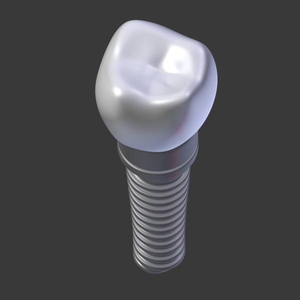 Tooth Implant - premolar